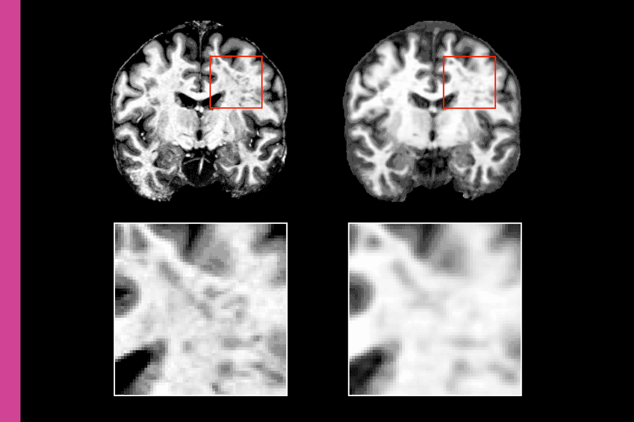Side-by-side grayscale brain scans in a coronal view. Each scan has a red square highlighting the same region in the right frontal area. Below, two enlarged close-ups show the highlighted region from each scan, with the left close-up appearing more detailed and the right more blurred, emphasizing differences in image clarity or tissue appearance.
