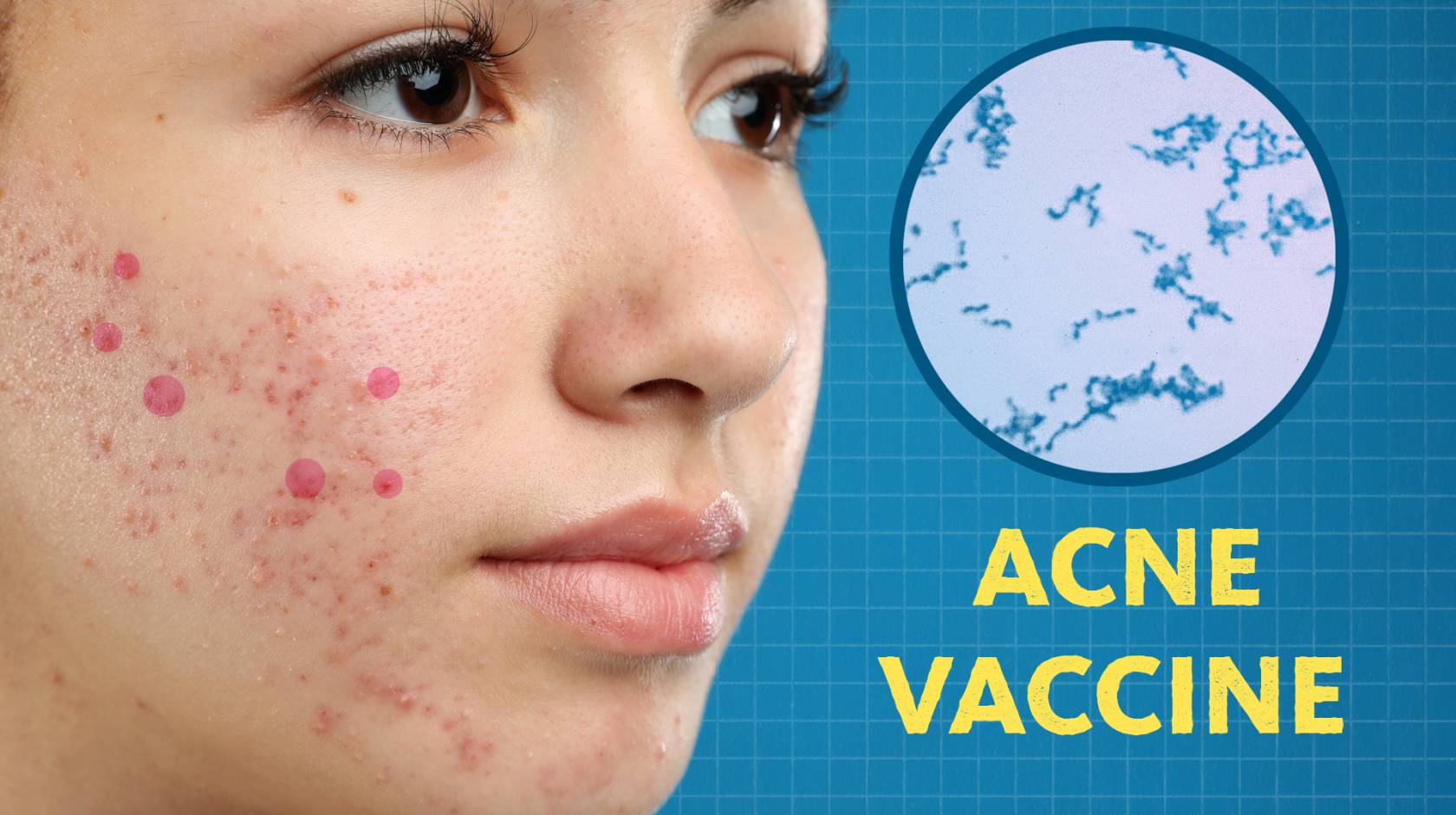 An image of a face with acne. Next to it is a microscopic view of Cutibacterium acnes. Below it are the words "acne vaccine"