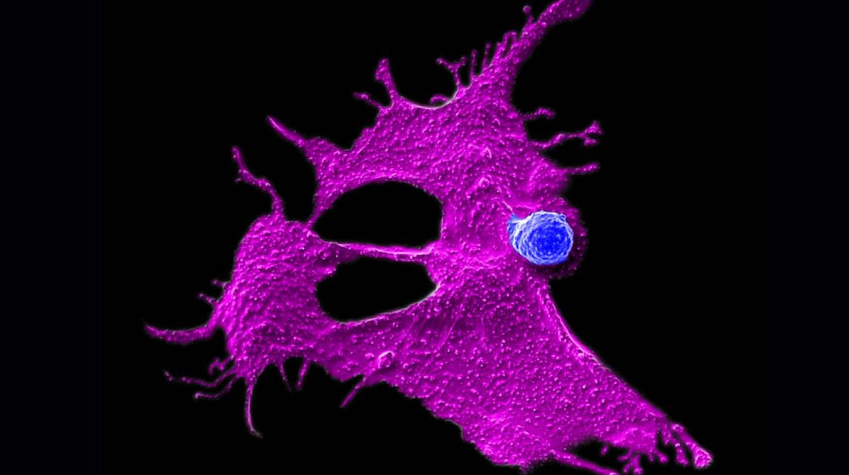 Microscopy image showing a very small stem cell-engineered CAR-NKT cell (blue dot) attacking a human solid tumor cell (magenta spread out, amoeba-like shape)