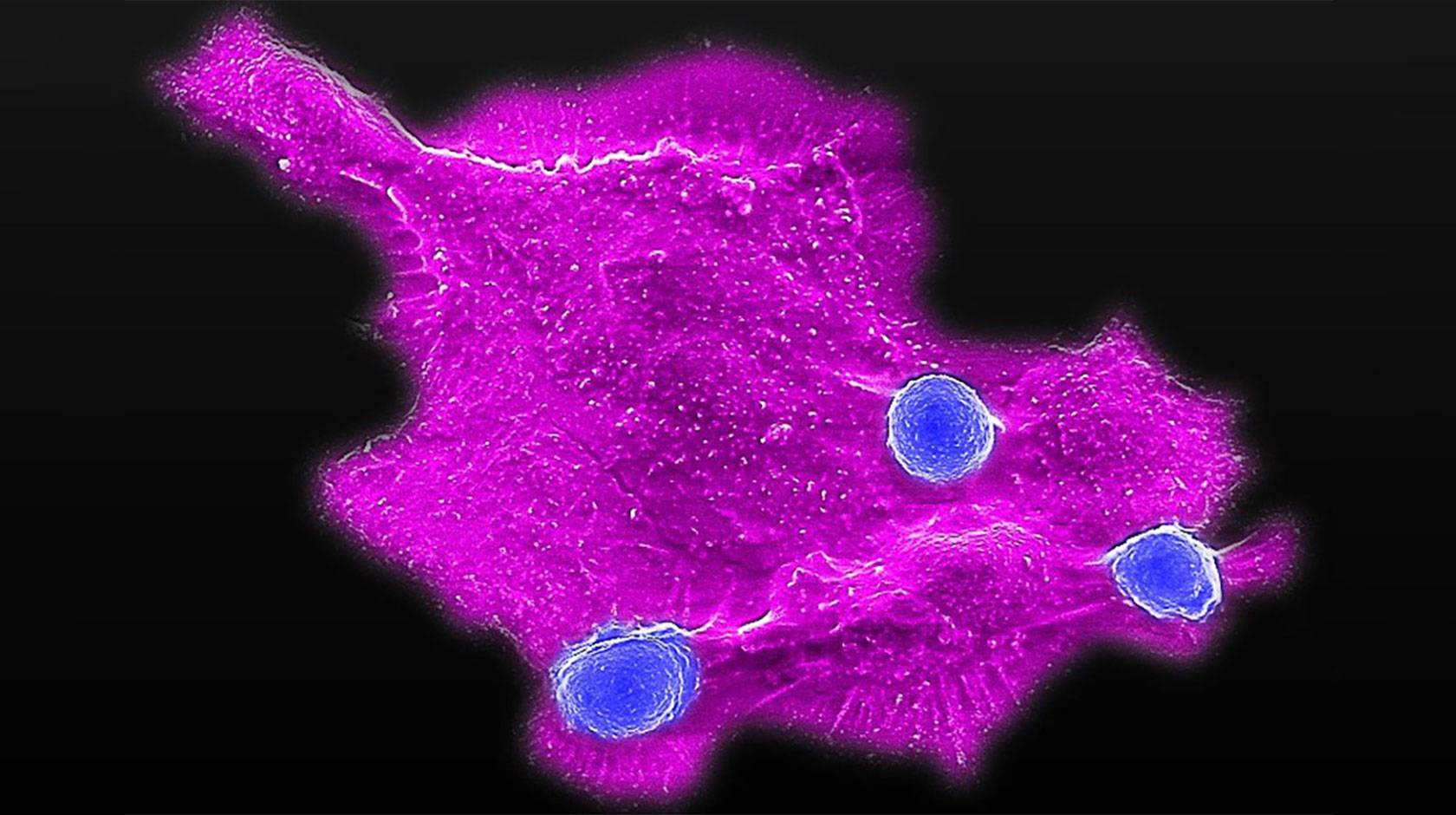 Fluorescence microscopy image showing a large magenta-colored breast cancer cell interacting with three smaller blue immune cells against a black background. The cancer cell has an irregular shape with extended protrusions, while the round immune cells appear to be attached to its surface.