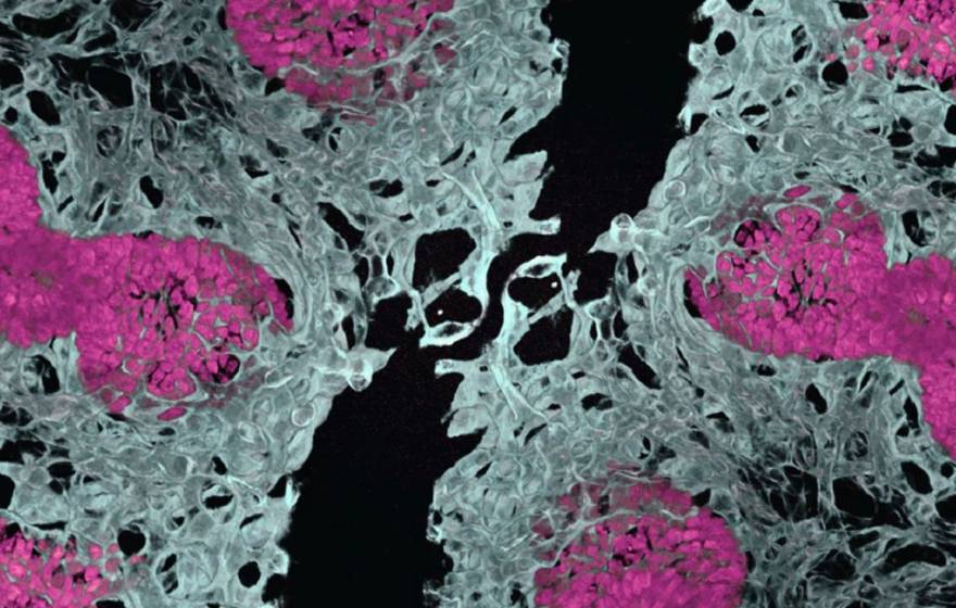 A microscope slide showing delicate gray structures interspersed with pink nodules, against a dark ground