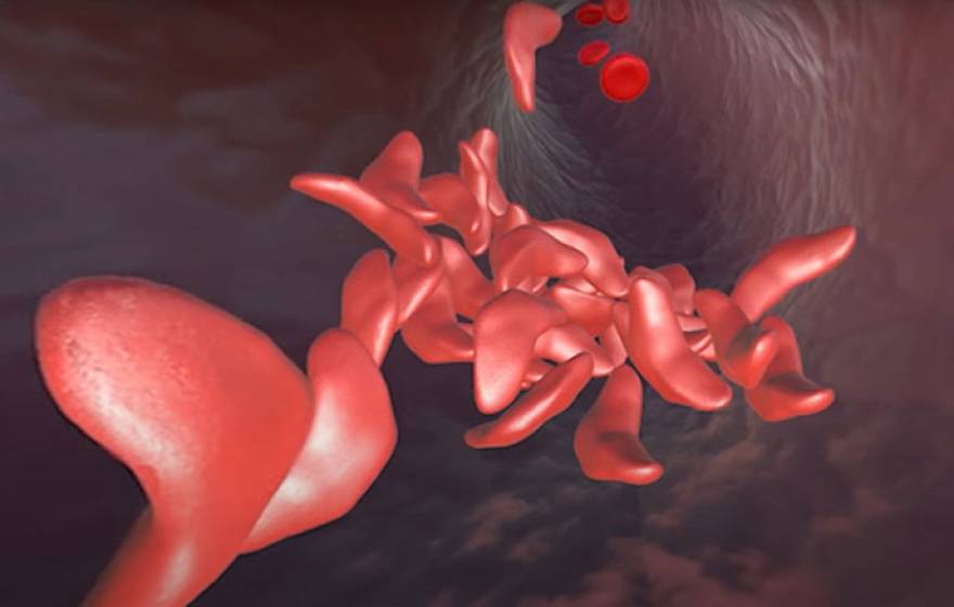 Sickled cells
