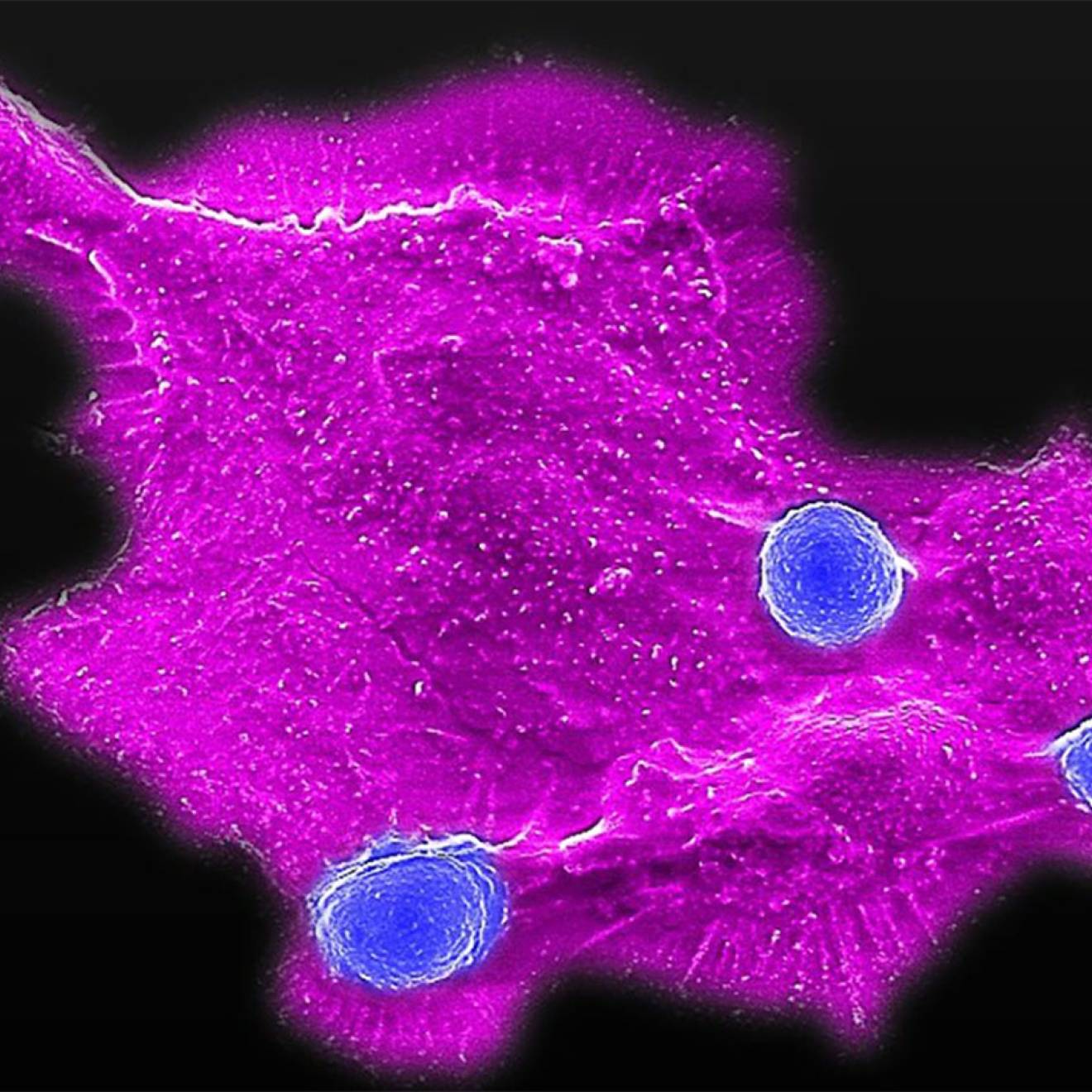 Fluorescence microscopy image showing a large magenta-colored breast cancer cell interacting with three smaller blue immune cells against a black background. The cancer cell has an irregular shape with extended protrusions, while the round immune cells appear to be attached to its surface.